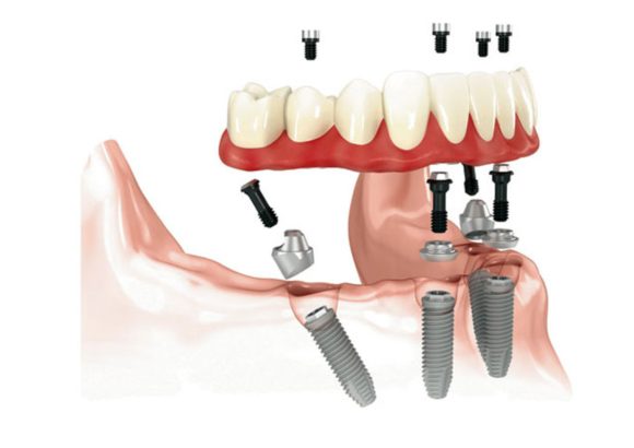 all on 4 dental implants oc